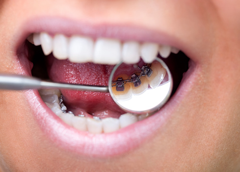 Female patient showing her invisible lingual braces braces on dental mirror